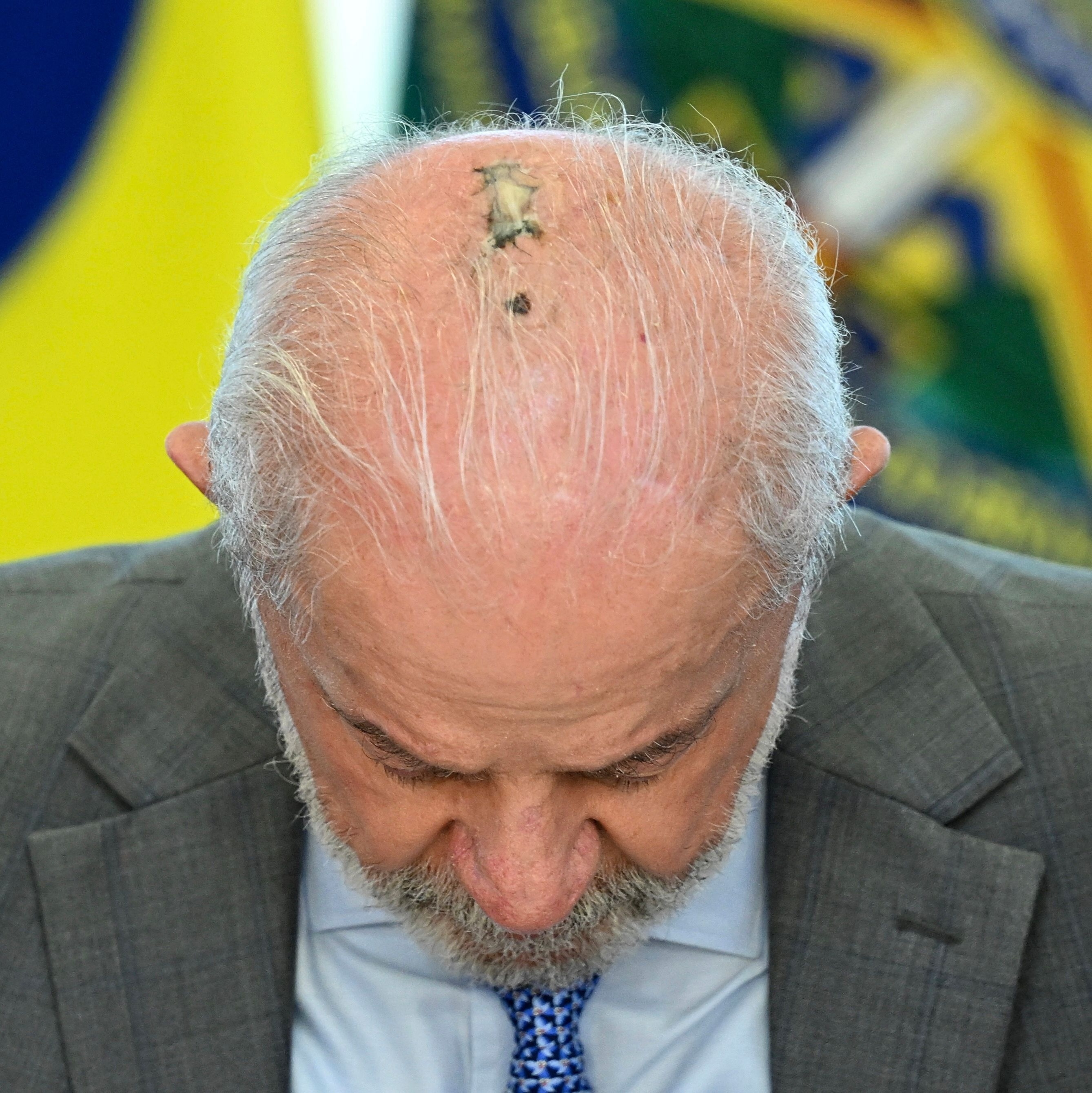 LULA PASSA POR NOVA SESSÃO DE RADIOTERAPIA APÓS RETIRADA DE CÂNCER DE PELE